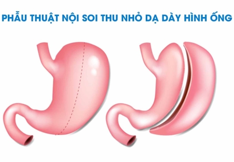 Sau khi thu nhỏ dạ dày có bị béo phì trở lại không?